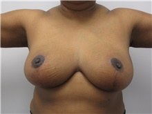 Breast Reduction After Photo by Sara Dickie, MD; Skokie, IL - Case 43154