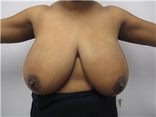 Breast Reduction Before Photo by Sara Dickie, MD; Skokie, IL - Case 43154