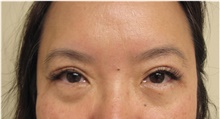 Eyelid Surgery After Photo by Sara Dickie, MD; Skokie, IL - Case 43155