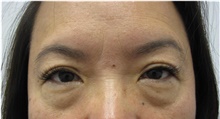Eyelid Surgery Before Photo by Sara Dickie, MD; Skokie, IL - Case 43155
