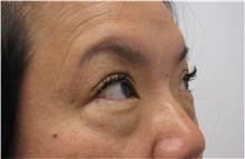 Eyelid Surgery Before Photo by Sara Dickie, MD; Morton Grove, IL - Case 43155