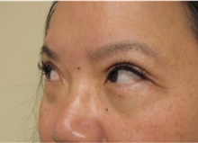 Eyelid Surgery After Photo by Sara Dickie, MD; Morton Grove, IL - Case 43155