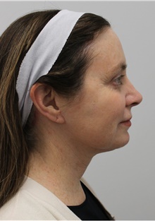 Facelift After Photo by Sara Dickie, MD; Morton Grove, IL - Case 43156