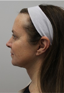 Facelift After Photo by Sara Dickie, MD; Morton Grove, IL - Case 43156
