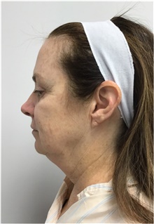 Facelift Before Photo by Sara Dickie, MD; Morton Grove, IL - Case 43156