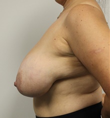 Breast Lift Before Photo by Sara Dickie, MD; Morton Grove, IL - Case 47825