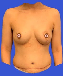 Breast Reconstruction After Photo by Peter Henderson, MD MBA FACS; New York, NY - Case 45466