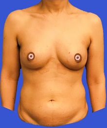 Breast Reconstruction Before Photo by Peter Henderson, MD MBA FACS; New York, NY - Case 45466