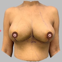 Breast Lift After Photo by Peter Henderson, MD MBA FACS; New York, NY - Case 45467