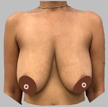 Breast Lift Before Photo by Peter Henderson, MD MBA FACS; New York, NY - Case 45467