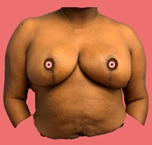 Breast Reduction After Photo by Peter Henderson, MD MBA FACS; New York, NY - Case 45468
