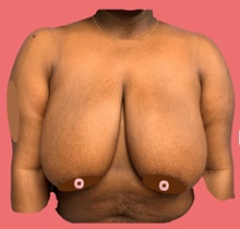 Breast Reduction Before Photo by Peter Henderson, MD MBA FACS; New York, NY - Case 45468