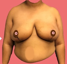 Breast Reduction After Photo by Peter Henderson, MD MBA FACS; New York, NY - Case 45471