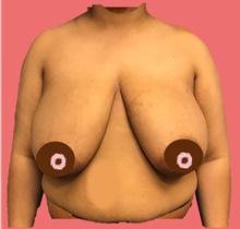 Breast Reduction Before Photo by Peter Henderson, MD MBA FACS; New York, NY - Case 45471