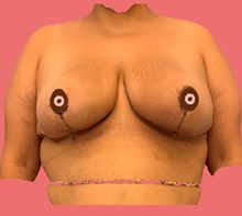 Breast Reduction After Photo by Peter Henderson, MD MBA FACS; New York, NY - Case 45472