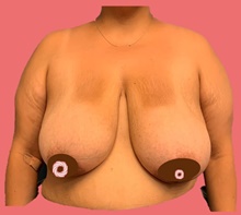 Breast Reduction Before Photo by Peter Henderson, MD MBA FACS; New York, NY - Case 45472