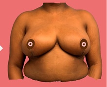 Breast Reduction After Photo by Peter Henderson, MD MBA FACS; New York, NY - Case 45473