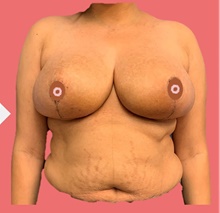 Breast Reduction After Photo by Peter Henderson, MD MBA FACS; New York, NY - Case 45476