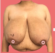 Breast Reduction Before Photo by Peter Henderson, MD MBA FACS; New York, NY - Case 45476