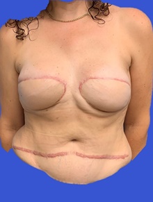 Breast Reconstruction After Photo by Peter Henderson, MD MBA FACS; New York, NY - Case 45478