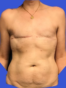 Breast Reconstruction Before Photo by Peter Henderson, MD MBA FACS; New York, NY - Case 45478