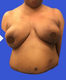 Breast Reconstruction After Photo by Peter Henderson, MD MBA FACS; New York, NY - Case 45479