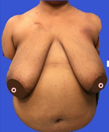 Breast Reconstruction Before Photo by Peter Henderson, MD MBA FACS; New York, NY - Case 45479