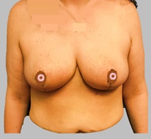 Breast Lift After Photo by Peter Henderson, MD MBA FACS; New York, NY - Case 45480