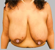 Breast Lift Before Photo by Peter Henderson, MD MBA FACS; New York, NY - Case 45480