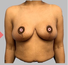Breast Lift After Photo by Peter Henderson, MD MBA FACS; New York, NY - Case 45481