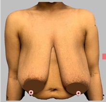 Breast Lift Before Photo by Peter Henderson, MD MBA FACS; New York, NY - Case 45481