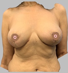 Breast Lift After Photo by Peter Henderson, MD MBA FACS; New York, NY - Case 45482