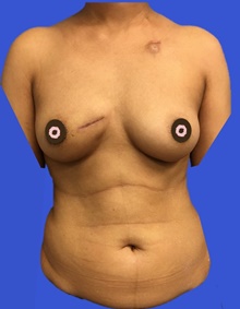 Breast Reconstruction Before Photo by Peter Henderson, MD MBA FACS; New York, NY - Case 45483