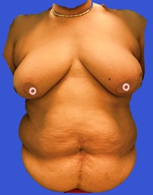 Breast Reconstruction Before Photo by Peter Henderson, MD MBA FACS; New York, NY - Case 45484