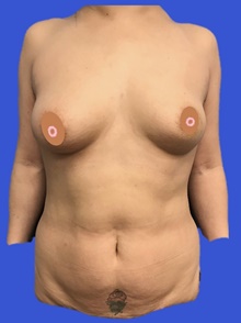 Breast Reconstruction Before Photo by Peter Henderson, MD MBA FACS; New York, NY - Case 45485