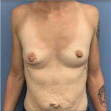Breast Augmentation Before Photo by Alexis Parcells, MD; Eatontown, NJ - Case 47005