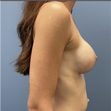 Breast Augmentation After Photo by Alexis Parcells, MD; Eatontown, NJ - Case 47005