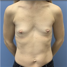 Breast Augmentation Before Photo by Alexis Parcells, MD; Eatontown, NJ - Case 47006