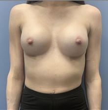 Breast Augmentation After Photo by Alexis Parcells, MD; Eatontown, NJ - Case 47007