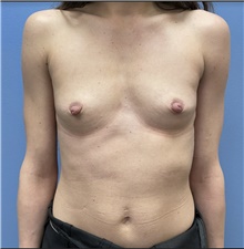 Breast Augmentation Before Photo by Alexis Parcells, MD; Eatontown, NJ - Case 47007