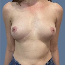 Breast Implant Removal After Photo by Alexis Parcells, MD; Eatontown, NJ - Case 47011