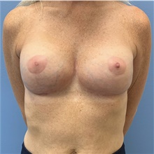 Breast Implant Removal After Photo by Alexis Parcells, MD; Eatontown, NJ - Case 47012