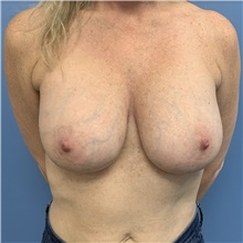 Breast Implant Removal Before Photo by Alexis Parcells, MD; Eatontown, NJ - Case 47012