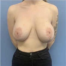 Breast Implant Removal Before Photo by Alexis Parcells, MD; Eatontown, NJ - Case 47013