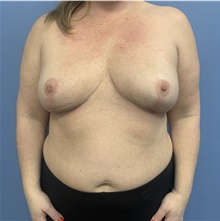 Breast Implant Removal After Photo by Alexis Parcells, MD; Eatontown, NJ - Case 47014