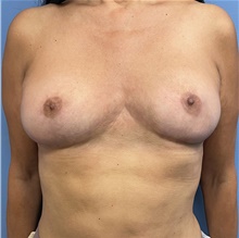 Breast Implant Removal After Photo by Alexis Parcells, MD; Eatontown, NJ - Case 47015