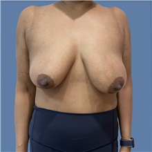 Breast Lift Before Photo by Alexis Parcells, MD; Eatontown, NJ - Case 47016