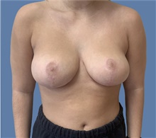 Breast Lift After Photo by Alexis Parcells, MD; Eatontown, NJ - Case 47017