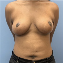 Breast Lift After Photo by Alexis Parcells, MD; Eatontown, NJ - Case 47020