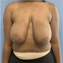Breast Lift Before Photo by Alexis Parcells, MD; Eatontown, NJ - Case 47020